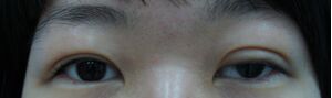 双眼皮修复需要慎重 可是我幸运的修复好了双眼皮
