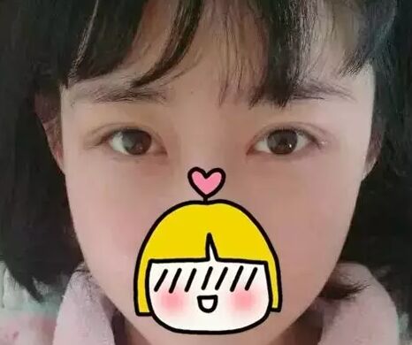 双眼皮修复需要慎重 可是我幸运的修复好了双眼皮