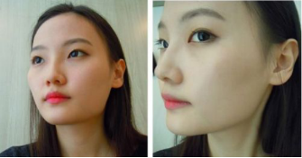 和大家分享北京301医院做的下颌角整形真实经