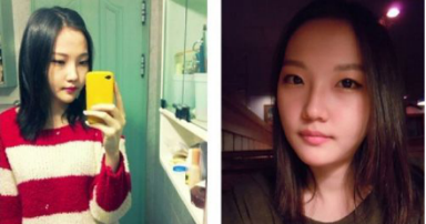 和大家分享北京301医院做的下颌角整形真实经