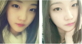 和大家分享北京301医院做的下颌角整形真实经