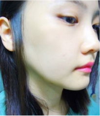 和大家分享北京301医院做的下颌角整形真实经