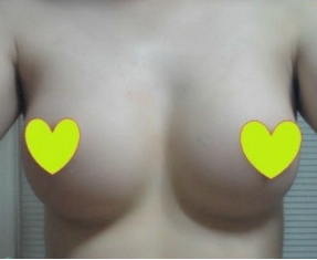 假体隆胸让我告别小平胸 感谢北京彤美