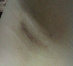 假体隆胸让我告别小平胸 感谢北京彤美