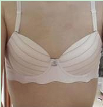 假体隆胸术让我告别小平胸 **