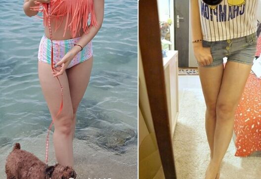 吸脂瘦大腿让我变回纤纤细腿