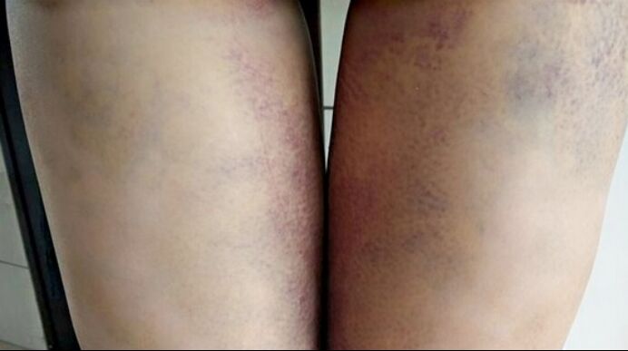 吸脂瘦大腿让我变回纤纤细腿