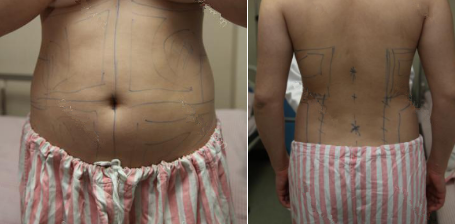 抽脂减肥瘦小腹 终于可以不用节食锻炼了