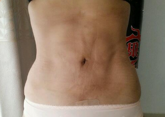 抽脂减肥瘦小腹 终于可以不用节食锻炼了