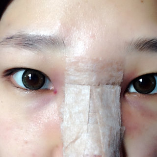 耳软骨隆鼻改变了我的塌鼻梁 北京彤美做的果很棒