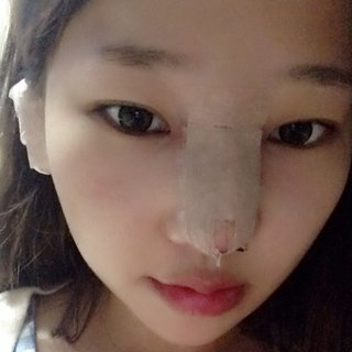 耳软骨隆鼻改变了我的塌鼻梁 北京彤美做的果很棒