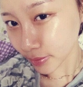 颧骨整形后我也变得甜美了