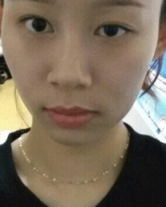 颧骨整形后我也变得甜美了