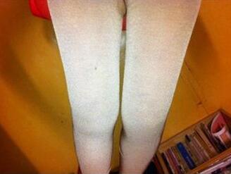 吸脂瘦大腿让我夏天放肆(｡･∀･)ﾉﾞ嗨