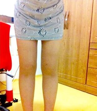 吸脂瘦大腿让我夏天放肆(｡･∀･)ﾉﾞ嗨