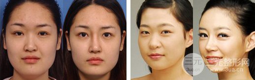 假体隆鼻术后几天可以洗脸，如何护理比较好