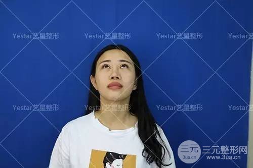 北京艺星薛轶群歪鼻孔矫正前后对比效果照片和