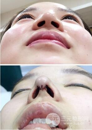 鼻头肥大矫正2