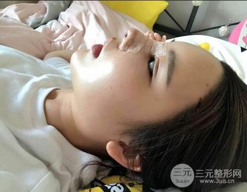 鼻头肥大矫正4