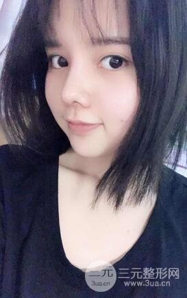 鼻头肥大矫正7