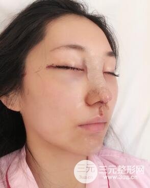 眼袋去除手术真实案例分享,附一周效果前后对