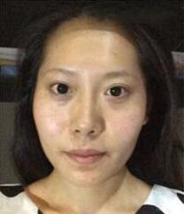 颧骨磨骨改脸型过程和恢复步骤照片（图）