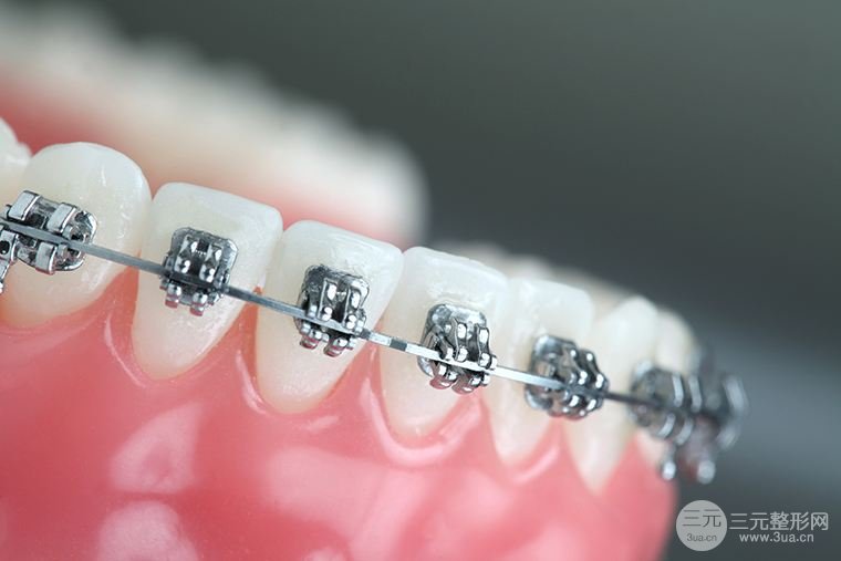 牙齿矫正过程是怎么样的？电脑前的你知道吗？
