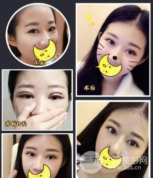 南充中心医院整形美容科双眼皮案例