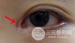 韩式开眼角整形手术容易留疤的原因，在这里
