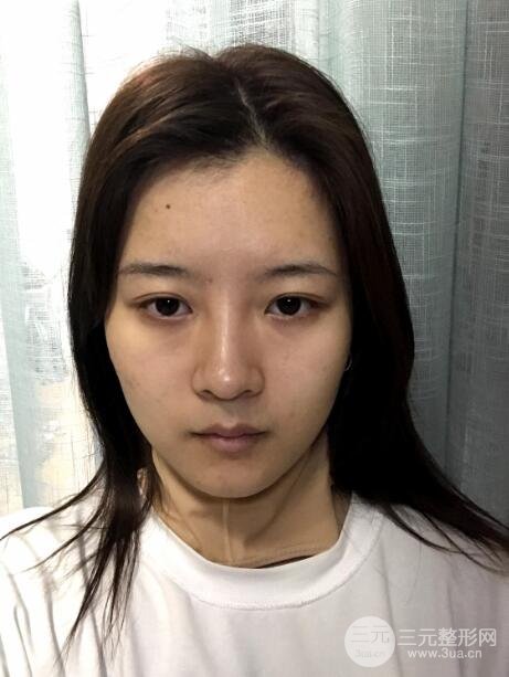 华西口腔王杭医生下颌角磨骨手术术后一个月
