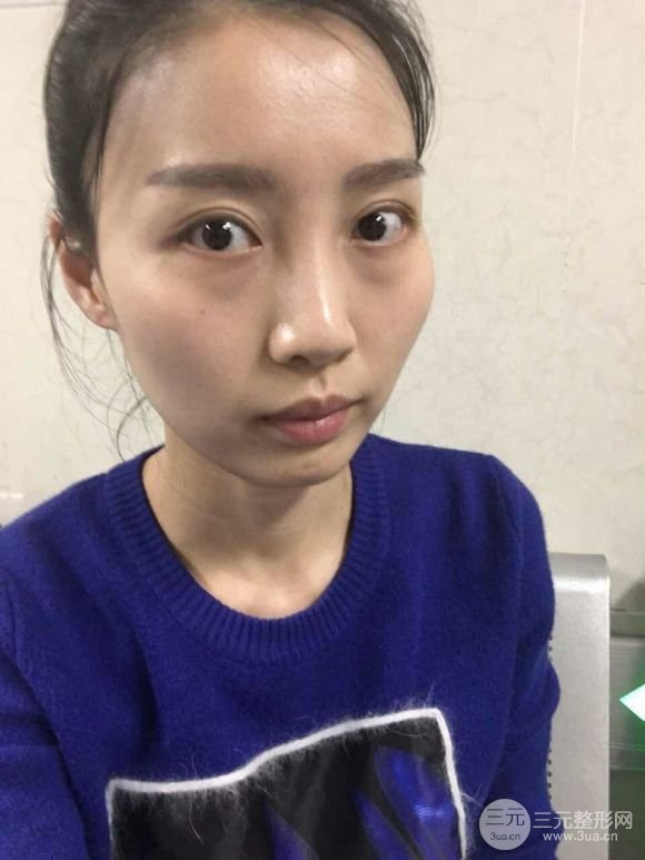 徐威强磨骨怎么样?【案例】美图赏析,v脸超美腻