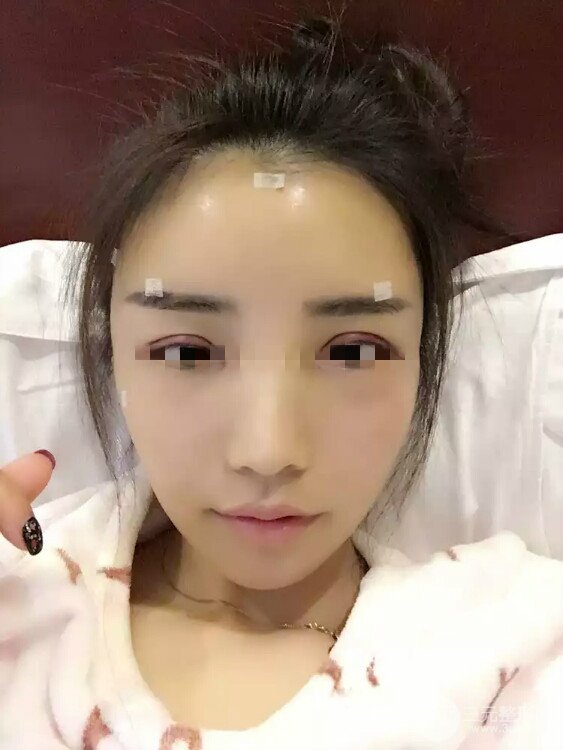 全脸脂肪填充5到10天照片 恢复美貌过程纪录,姐妹们看