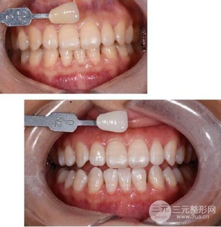 牙齿贴面美白果分享