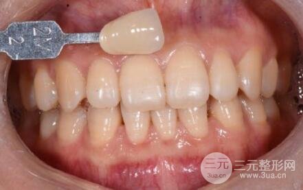 牙齿贴面美白果分享