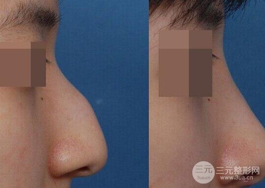 驼峰鼻整形的手术方法