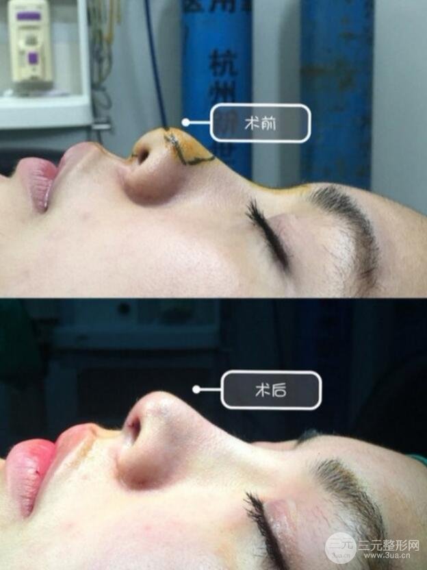 鼻尖整形手术对比图