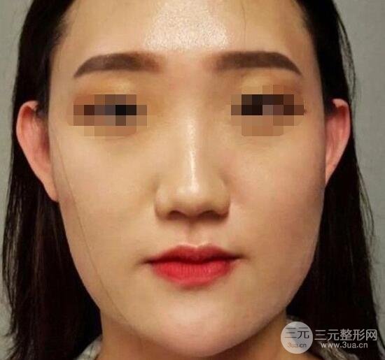 真人|北京八大处磨骨削骨前后对比照,医生|专家一览