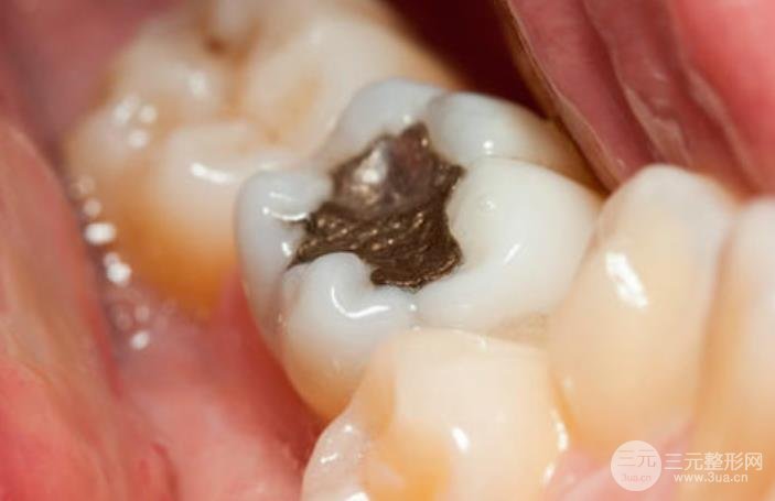 牙齿根部发黑是什么原因?如何治疗?