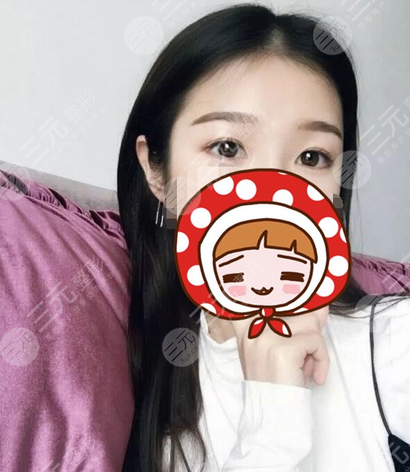 上海九院整形美容外科张路医生双眼皮案例