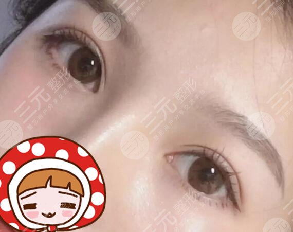 上海九院整形美容外科张路医生双眼皮案例