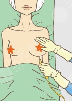 曼托假体隆胸+自体脂肪隆胸真人案例恢复过程照片