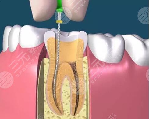 牙髓炎根管缓解费用