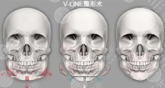 V-LINE瓜子脸手术是磨骨吗