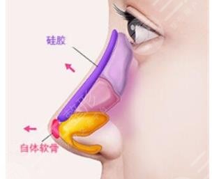 上海隆鼻专家介绍