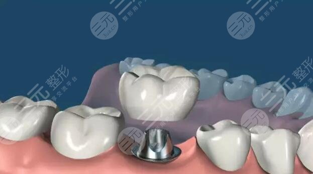 种植牙技术手术的优势有哪些