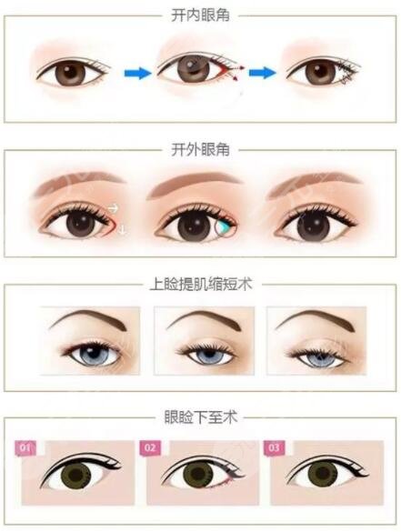 眼部手术手术项目包括哪些?