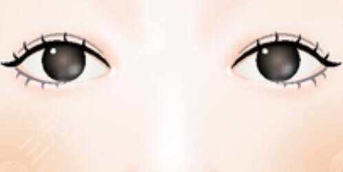 韩式微创双眼皮手术 让我的眼晴变得更漂亮了