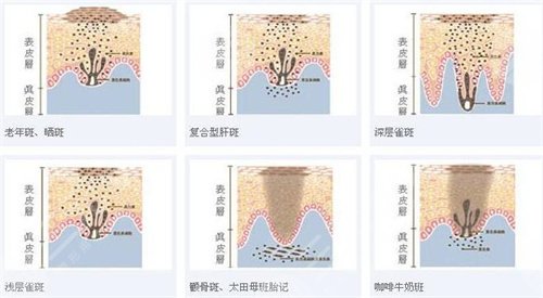 北京大学深圳医院整形外科激光祛斑案例：术后一天