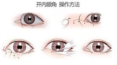开眼角前后对比图 原理