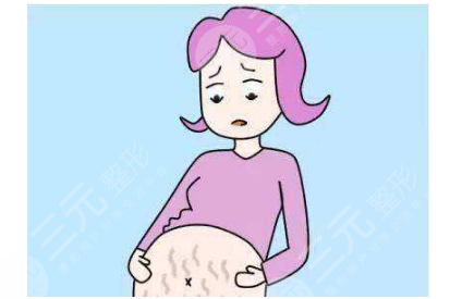 产后如何去掉腹部肚皮妊娠纹 去除产后腹部肚皮妊娠纹的喜欢办法